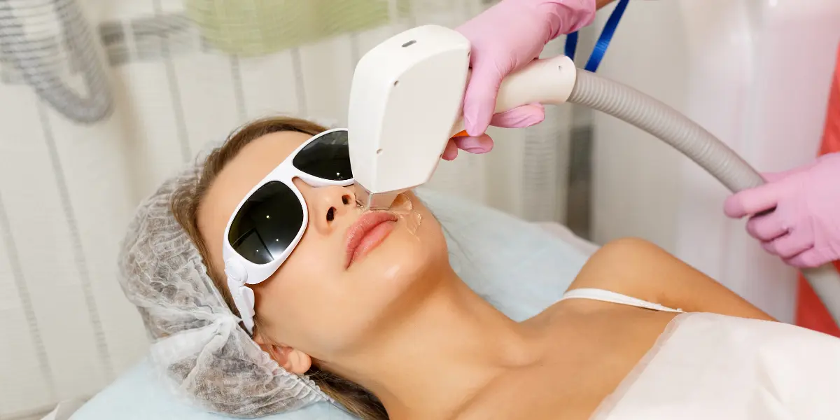 Depilação a Laser no Buço