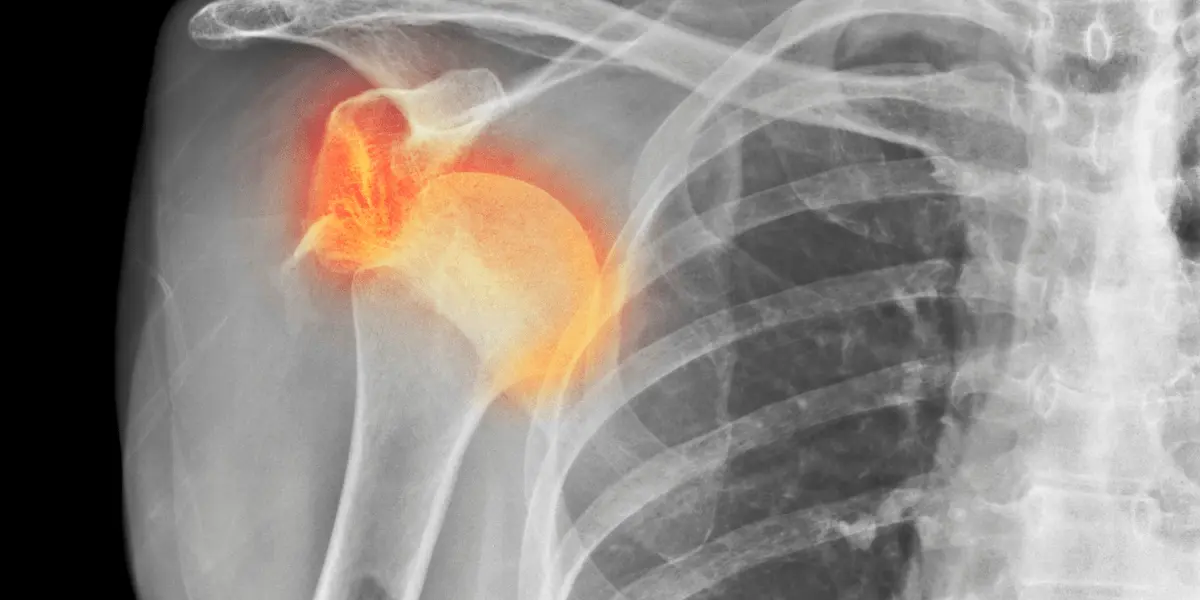 Quais são os sintomas de ombro inflamado