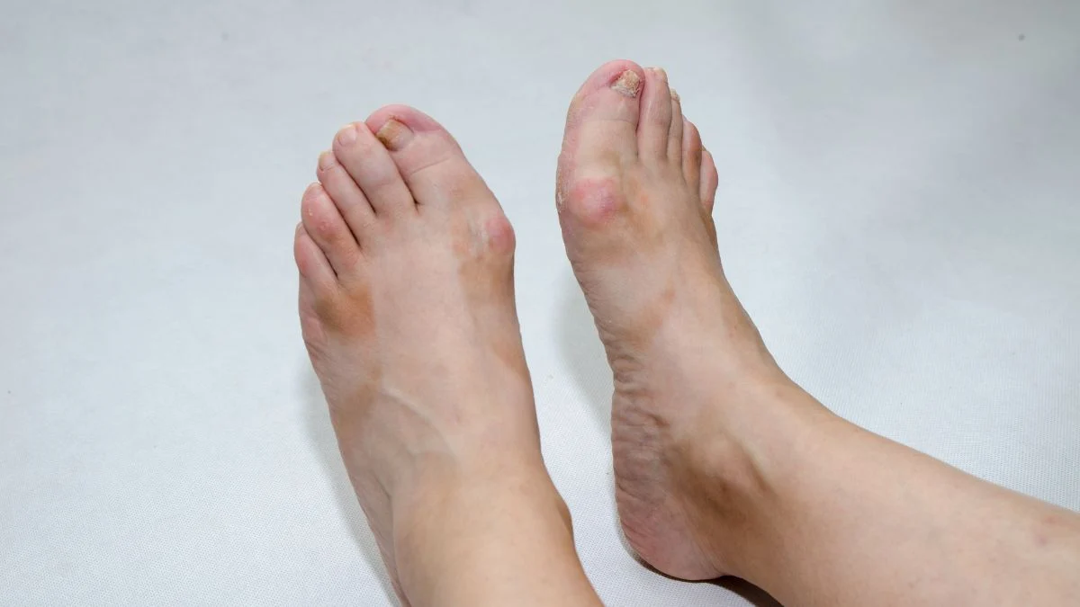 Quem tem joanete pode usar chinelo de dedo